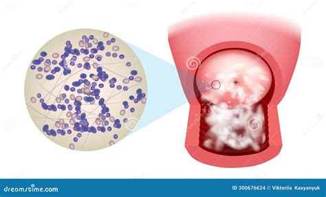 Illustration Of A Candidiasis Infection On The Cervix. Vaginal ...