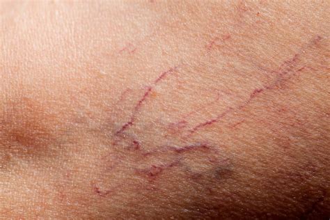 How to Erase (And Prevent) Broken Capillaries | Reader's Digest