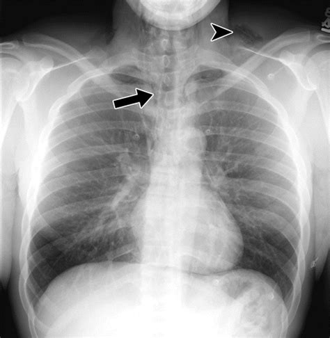 Imaging Manifestations of Chest Trauma | RadioGraphics