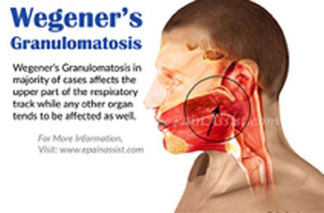 Wegener’s Granulomatosis