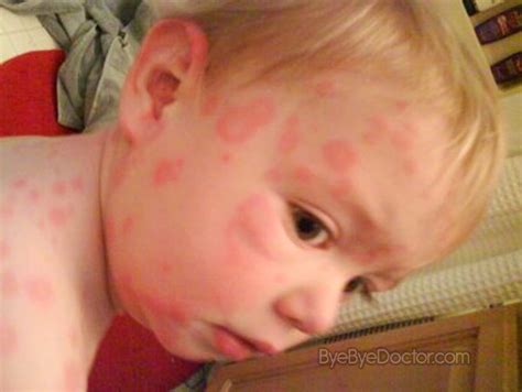 Fifth Disease Slap Cheek submited images | Pic2Fly