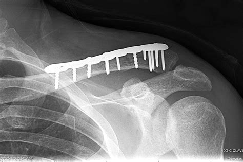 BROKEN CLAVICLE FIXED | Buyxraysonline