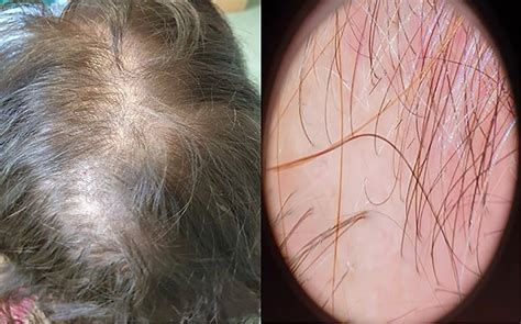 Telogen Effluvium Hair Loss Treatment Birmingham