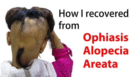 How I Recovered From Ophiasis Alopecia Areata | Patient Testimonial ...