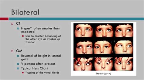 Cranial Nerve 4 Palsy