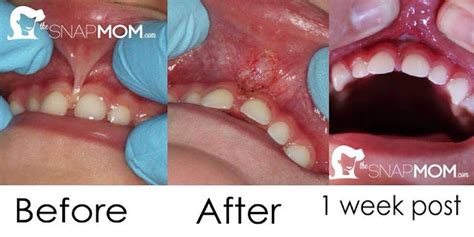 Dentist East Berlin PA: Lip-Tie Images: Pre & Post Lip-Tie Treatment