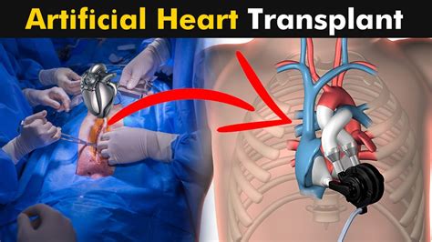 How does Artificial Heart transplant surgery works? | Artificial Hearts ...