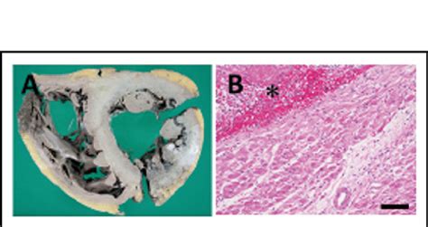 Alcoholic cardiomyopathy (autopsy case). (A) Gross pathological finding ...