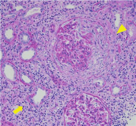 Pathological findings of kidney biopsy. Kidney biopsy revealed... | Download Scientific Diagram