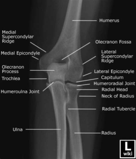 Olecranon Fossa X Ray