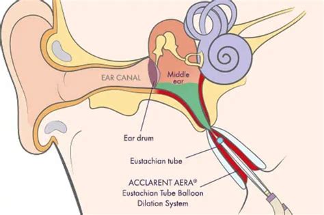 Eustachian Tube Dysfunction | CareCredit | North Dallas ENT