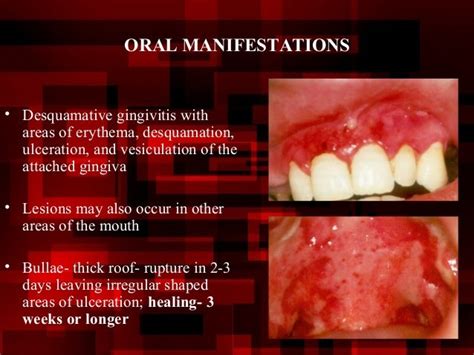 DESQUAMATIVE GINGIVITIS PDF