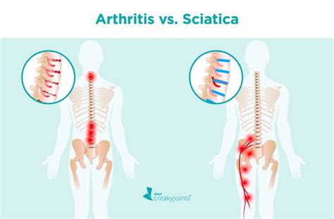 Arthritis vs. Sciatica: Differences in Risk Factors, Symptoms, Treatments