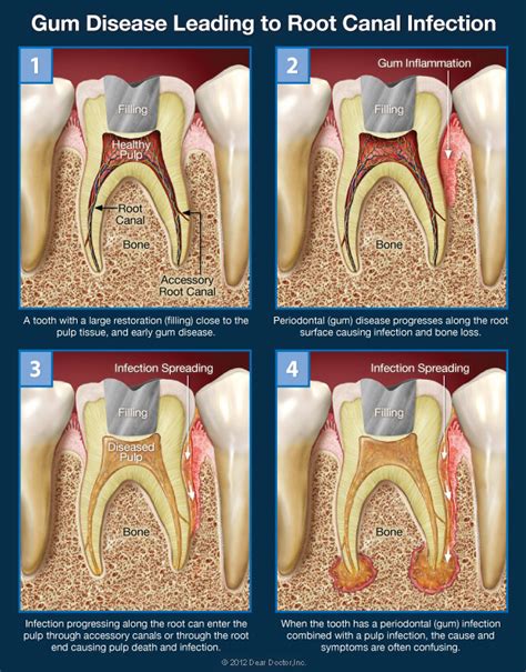 Confusing Tooth Pain