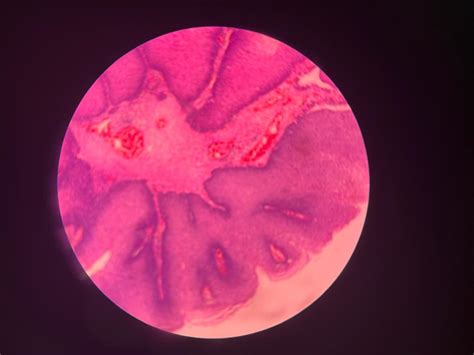 Laryngeal papillomatosis in an adult patient: managed with ...