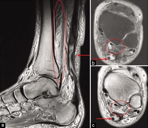 Flexor Hallucis Longus Mri