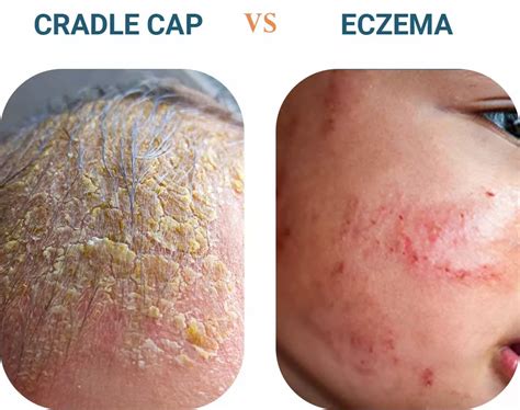 Costra láctea vs. eczema: ¿Cuál es la diferencia?