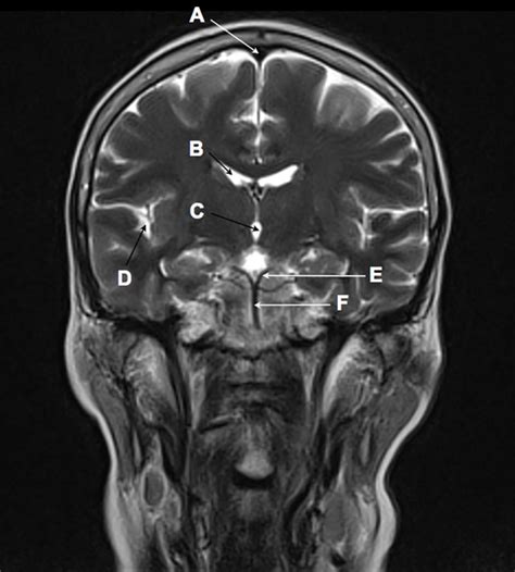Mri Brain Anatomy Radiology Masterclass - ANATOMY STRUCTURE