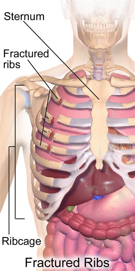 Rib Fracture - Physiopedia