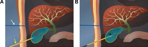 Percutaneous Cholecystostomy