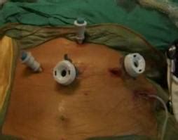 Gastric Bypass Kills: Facts About Lap-Band® Surgery Failure