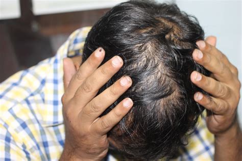 Seborrheic Dermatitis Scalp Hair Loss