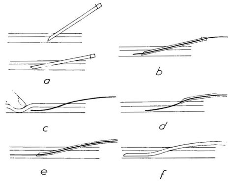 Seldinger Technique • LITFL • Medical Eponym Library