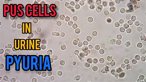 Pus Cells In Urine || Pyuria || How To Identify Pus Cells In Urine || UTI ||Causes Of Pyuria ...