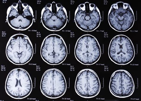 What are the Most Common MRI Side Effects? (with pictures)