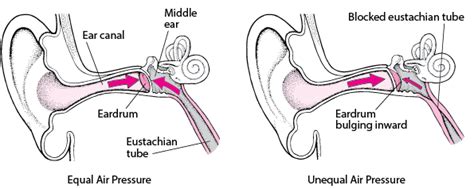 Barotrauma of the Ear - Ear, Nose, and Throat Disorders - MSD Manual Consumer Version