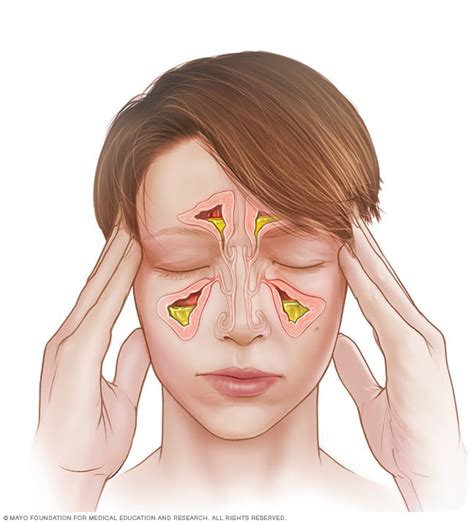 Acute Sinusitis And Rhinosinusitis