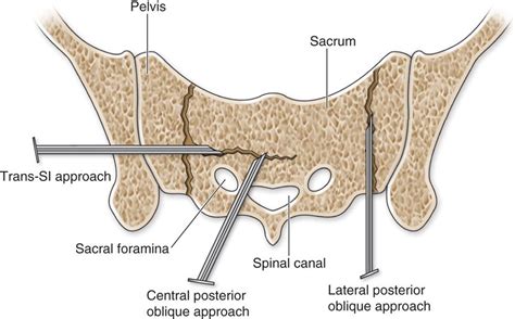 Percutaneous Sacroplasty | Anesthesia Key