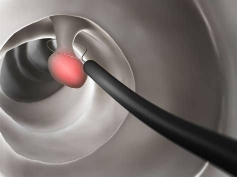 Diverticulosis Colonoscopy