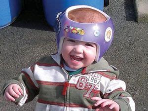 Helmets a Bad 'Fit' for Flat Head Syndrome | Flat head syndrome, Baby ...