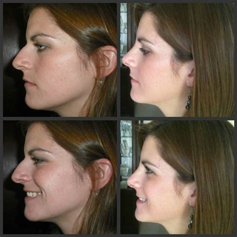 My Rhinoplasty Recovery: Before and After Pictures: Day 5