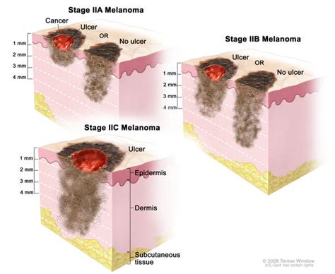 Understanding Melanoma: Treatment Options for Stage II Melanoma