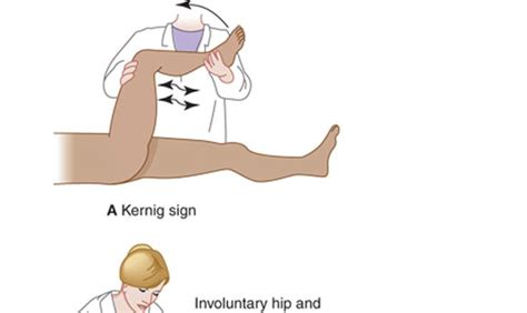 Learn about Kernig sign and Brudzinski sign. How to perform Kernig and Brudzinski test. What are ...