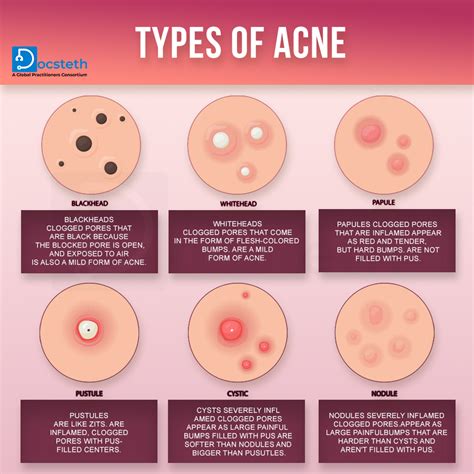 Pustule Vs Papule