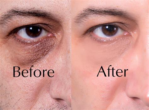 Dark eye circles - DR.D Clinic | LCP Certified Aesthetic Clinic Kuala Lumpur (KL), Malaysia