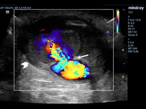 Dialysis Fistula Ultrasound