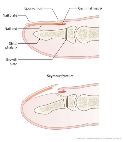 Distal Phalanx Fracture