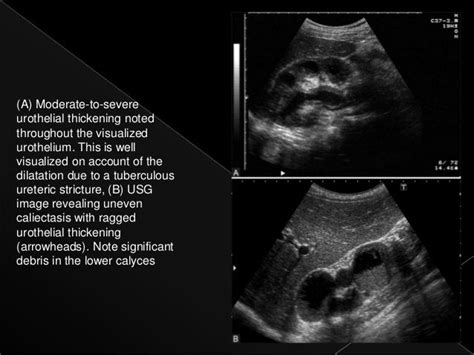 Renal tuberculosis radiology