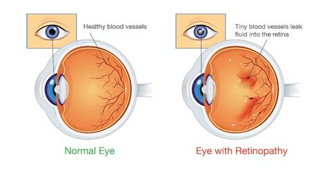 What You Need to Know About Diabetic Retinopathy | Campus Eye Center