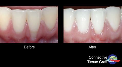 What is gum recession? Causes, Symptoms, and Treatment - Dr. Peter Fritz