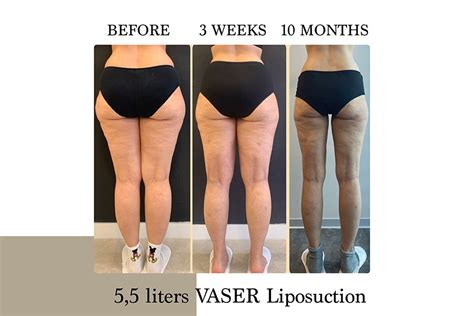 Lipedema | Before & After