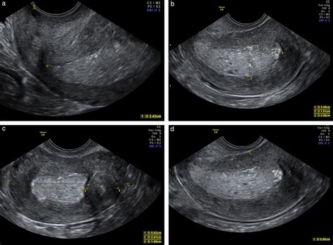 Ultrasound Scanning Of The Pelvis And Abdomen For Staging, 43% OFF