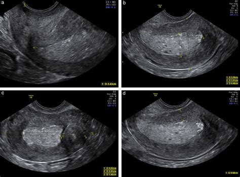 [36+] Uterine Cancer Ultrasound Endometrial Hyperplasia