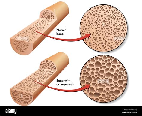 calcium menopause osteoporosis Stock Photo - Alamy