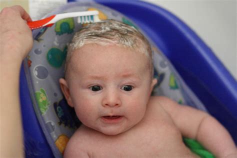 5 Natural Remedies for Cradle Cap (Seborrheic Dermatitis)