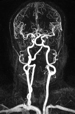 Ultimate Radiology : Dolichoectasia of the Vertebrobasilar System